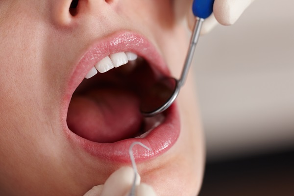 The Difference Between Dental Inlays And Dental Fillings