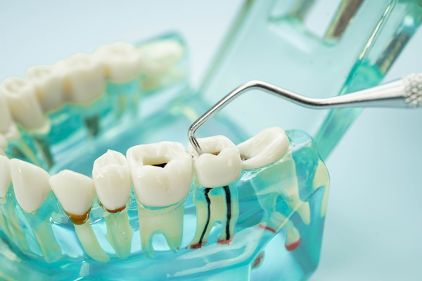 Root Canal Aftercare: Tips For A Smooth Recovery